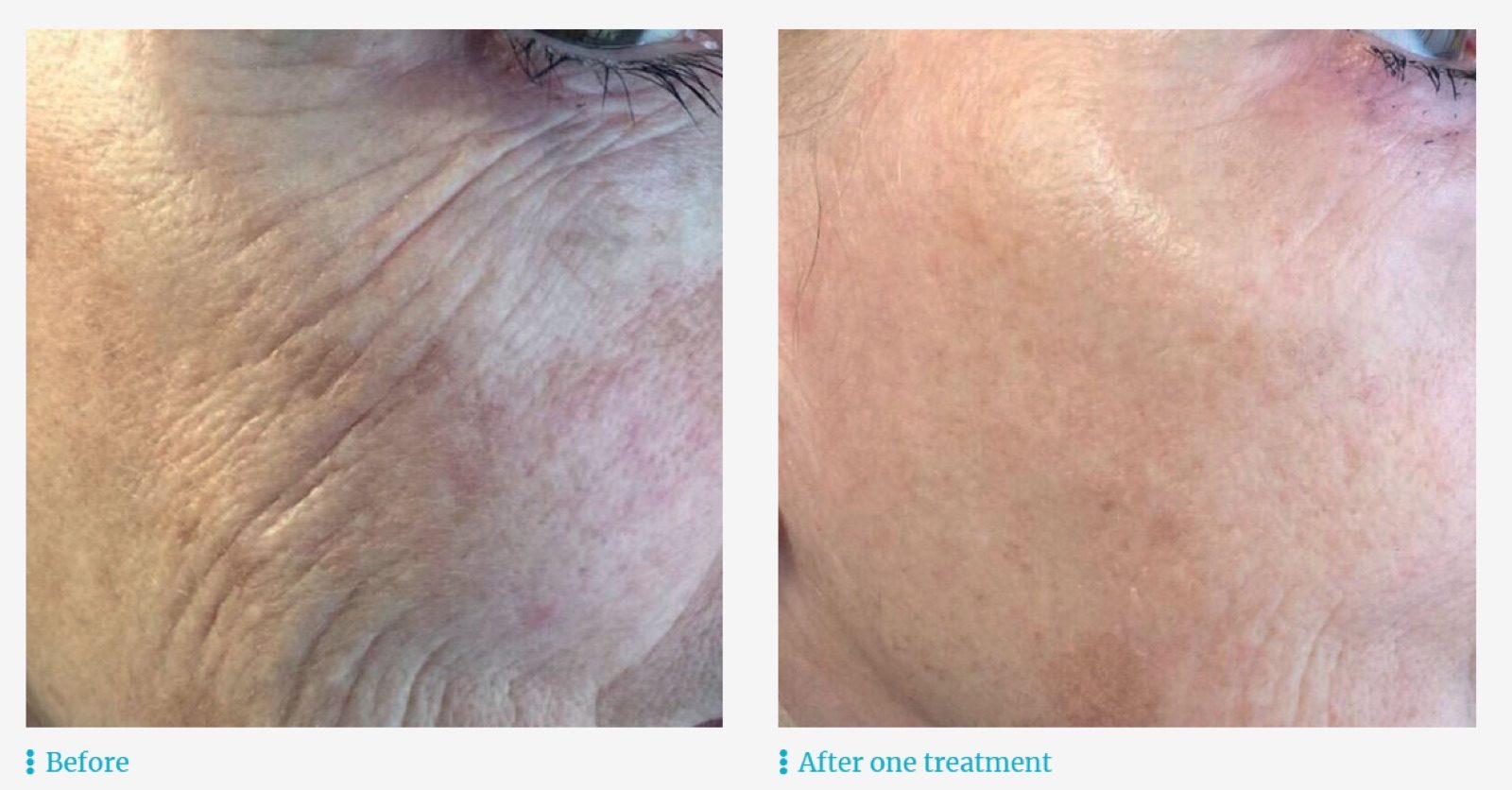 Plasma skin tightening around the eyes, before and after one treatment