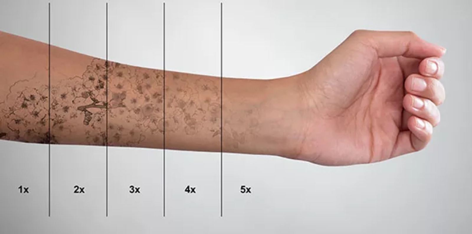 Typical tattoo fade progression across removal sessions